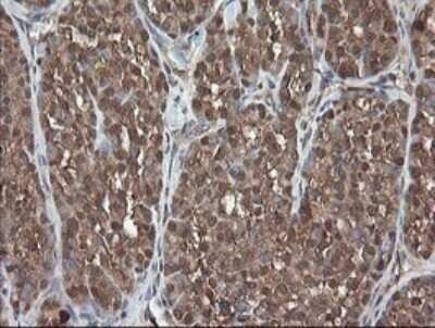 Immunohistochemistry: PNPO Antibody (OTI1G9) [NBP2-45361] - Analysis of Carcinoma of Human thyroid tissue.