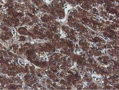 Immunohistochemistry: PNPO Antibody (OTI1H9) - Azide and BSA Free [NBP2-73508] - Staining of paraffin-embedded Carcinoma of Human liver tissue using anti-PNPO mouse monoclonal antibody.