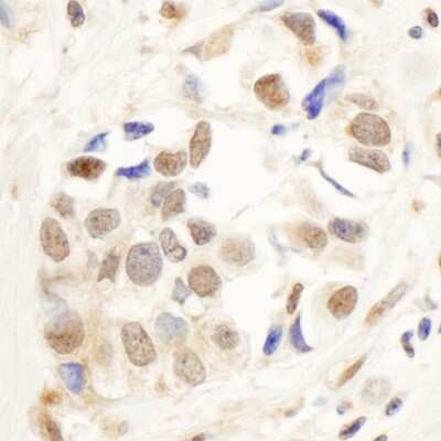 Immunohistochemistry: PNUTS/PPP1R10 Antibody [NB100-604] - Sample: FFPE section of human breast carcinoma. Antibody: Affinity purified rabbit anti- PNUTS used at a dilution of 1:1,000 (1ug/ml). Detection: DAB