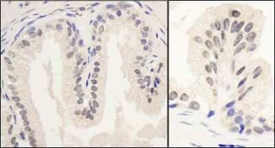 Immunohistochemistry: PNUTS/PPP1R10 Antibody [NB100-604] - Sample: FFPE section of human prostate carcinoma. Antibody: Affinity purified rabbit anti- PNUTS used at a dilution of 1:1,000 (1ug/ml). Detection: DAB