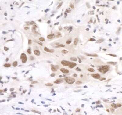 Immunohistochemistry: PNUTS/PPP1R10 Antibody [NB100-604] - Detection of human PNUTS by immunohistochemistry. Sample: FFPE section of human breast carcinoma. Antibody: Affinity purified rabbit anti- PNUTS (NB100-604). Detection: DAB