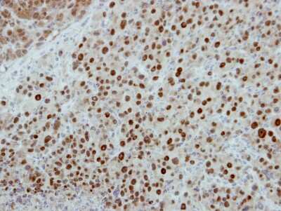 Immunohistochemistry-Paraffin: POLR1D Antibody [NBP2-19884] - Immunohistochemical analysis of paraffin-embedded HBL435 xenograft, using antibody at 1:500 dilution.