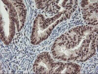 Immunohistochemistry-Paraffin: POLR2E Antibody (OTI3B5) [NBP2-00482] - Staining of paraffin-embedded Adenocarcinoma of Human endometrium tissue using anti-POLR2E mouse monoclonal antibody.