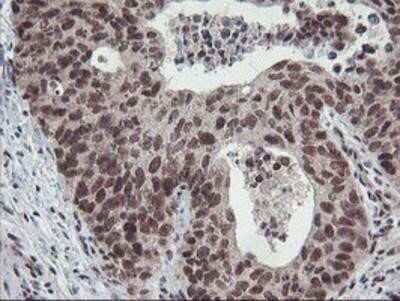 Immunohistochemistry-Paraffin: POLR2E Antibody (OTI3B5) [NBP2-00482] - Staining of paraffin-embedded Carcinoma of Human lung tissue using anti-POLR2E mouse monoclonal antibody.