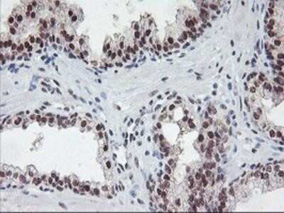 Immunohistochemistry-Paraffin: POLR2E Antibody (OTI3B5) [NBP2-00482] - Staining of paraffin-embedded Carcinoma of Human prostate tissue using anti-POLR2E mouse monoclonal antibody.