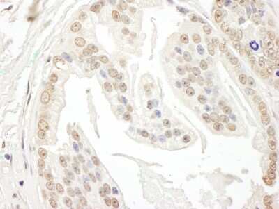 <b>Independent Antibodies Validation and Biological Strategies Validation.</b>Immunohistochemistry: POLR3D Antibody [NBP1-28737] - Sample: FFPE section of human prostate carcinoma. Antibody: Affinity purified rabbit anti- POLR3D used at a dilution of 1:1,000 (0.2 ug/ml). Detection: DAB