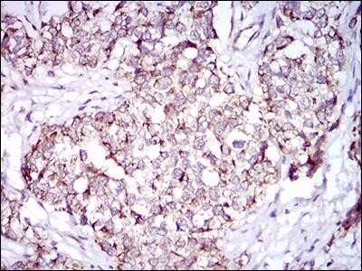 Immunohistochemistry-Paraffin: PON1 Antibody (4G8D3) - Azide and BSA Free [NBP2-80919] - Immunohistochemical analysis of paraffin-embedded human bladder cancer tissues with DAB staining. Image from the standard format of this antibody.