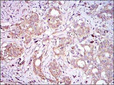 Immunohistochemistry: PON1 Antibody (4G8D3) [NBP2-23610] - Immunohistochemical analysis of paraffin-embedded human cervical cancer tissues with DAB staining.