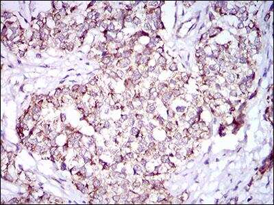 Immunohistochemistry: PON1 Antibody (4G8D3) [NBP2-23610] - Immunohistochemical analysis of paraffin-embedded human bladder cancer tissues with DAB staining.