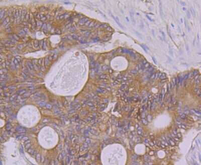 Immunohistochemistry-Paraffin: PON2 Antibody (JG35-80) [NBP2-75625] - Analysis of paraffin-embedded human colon cancer tissue using anti-PON2 antibody. Counter stained with hematoxylin.