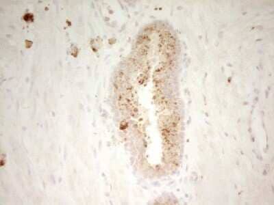 Immunohistochemistry: PON3 Antibody (OTI5C3) - Azide and BSA Free [NBP2-73530] - Analysis of Adenocarcinoma of Human endometrium tissue. (Heat-induced epitope retrieval by 1 mM EDTA in 10mM Tris, pH8.5, 120C for 3min)