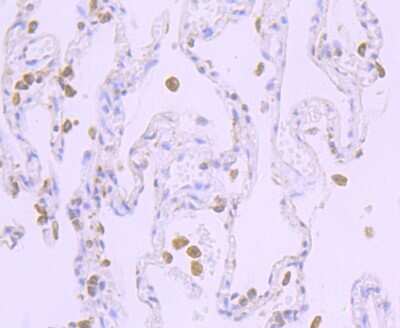 Immunohistochemistry-Paraffin: POR/Cytochrome P450 Reductase Antibody (JB54-31) [NBP2-75626] - Analysis of paraffin-embedded human lung cancer tissue using anti-Cytochrome P450 Reductase antibody. Counter stained with hematoxylin.