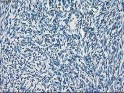 Immunohistochemistry: POR/Cytochrome P450 Reductase Antibody (OTI3F10) - Azide and BSA Free [NBP2-73539] - Staining of paraffin-embedded Adenocarcinoma of Human colon tissue using anti-Cytochrome P450 Reductase mouse monoclonal antibody.