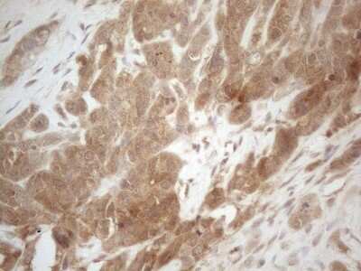 Immunohistochemistry: PP1 alpha/PPP1A Antibody (OTI6E5) - Azide and BSA Free [NBP2-73542] - Staining of paraffin-embedded Adenocarcinoma of Human endometrium tissue using anti-PPP1CA mouse monoclonal antibody. (Heat-induced epitope retrieval by 1mM EDTA in 10mM Tris buffer (pH8.5) at 120C for 3min) (1:150)