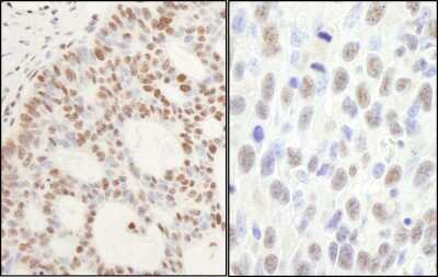 Immunohistochemistry: PP2C gamma/PPM1G Antibody [NB110-38867] - Sample: FFPE sections of human skin basal cell carcinoma (left) and mouse squamous cell carcinoma (right). Antibody: Affinity purified rabbit anti- PPM1G used at a dilution of 1:1,000 (0.2ug/ml) and 1:200 (1ug/ml). Detection: DAB