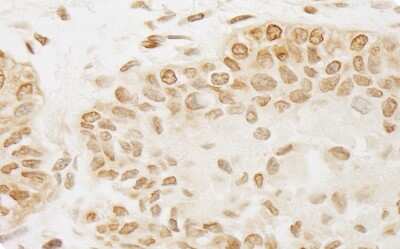 Immunohistochemistry: PP5 Antibody [NB110-40555] - Sample: FFPE section of human prostate carcinoma. Antibody: Affinity purified rabbit anti- PPP5C used at a dilution of 1:200 (1ug/ml). Detection: DAB