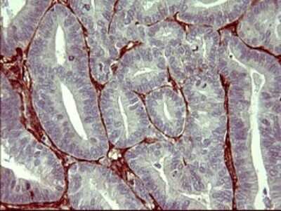 Immunohistochemistry: PPAP2A Antibody (1H4) [NBP2-45378] - Analysis of Adenocarcinoma of Human endometrium tissue. (Heat-induced epitope retrieval by 10mM citric buffer, pH6.0, 120C for 3min)