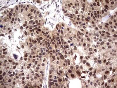 Immunohistochemistry: PPIL1 Antibody (OTI2D1) - Azide and BSA Free [NBP2-73573] - Analysis of Carcinoma of Human kidney tissue using PPIL1 mouse monoclonal antibody. (Heat-induced epitope retrieval by 1 mM EDTA in 10mM Tris, pH8.5, 120C for 3min)