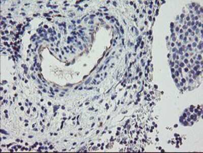 Immunohistochemistry-Paraffin: PPIL6 Antibody (4F2) [NBP2-03728] - Staining of paraffin-embedded Carcinoma of Human bladder tissue using anti-PPIL6 mouse monoclonal antibody.