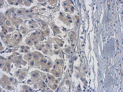 Immunohistochemistry-Paraffin: PPME1 Antibody [NBP2-19903] - Immunohistochemical analysis of paraffin-embedded Hepatoma, using antibody at 1:500 dilution.