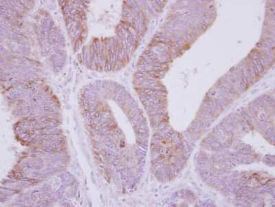 Immunohistochemistry-Paraffin: PPP2R3A Antibody [NBP2-19908] - Immunohistochemical analysis of paraffin-embedded Colon ca, using antibody at 1:250 dilution.