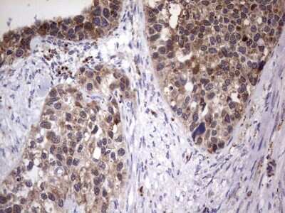 Immunohistochemistry: PPP2R5D Antibody (5E7) [NBP2-45387] - Analysis of Carcinoma of Human kidney tissue. (Heat-induced epitope retrieval by 1 mM EDTA in 10mM Tris, pH8.5, 120C for 3min)