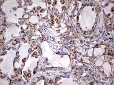 Immunohistochemistry: PPP2R5D Antibody (5E7) [NBP2-45387] - Analysis of Carcinoma of Human lung tissue.(Heat-induced epitope retrieval by 1 mM EDTA in 10mM Tris, pH8.5, 120C for 3min)