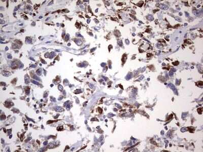 Immunohistochemistry: PPP2R5D Antibody (5E7) [NBP2-45387] - Analysis of Adenocarcinoma of Human ovary tissue. (Heat-induced epitope retrieval by 1 mM EDTA in 10mM Tris, pH8.5, 120C for 3min)