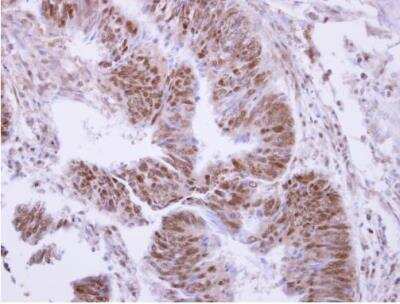 Immunohistochemistry-Paraffin: PPP4C Antibody [NBP1-31117] - Sample: Paraffin-embedded colon carcinoma. PPP4C antibody, N-term dilution: 1:500.