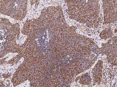 Immunohistochemistry-Paraffin: PRG-1/LPPR4 Antibody [NBP2-98915] - Immunochemical staining of human PRG-1/LPPR4 in human lung cancer with rabbit polyclonal antibody (1:1000, formalin-fixed paraffin embedded sections).