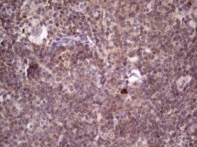 Immunohistochemistry: PRKD3/nPKC nu Antibody (OTI3D8) - Azide and BSA Free [NBP2-73595] - Analysis of Carcinoma of Human lung tissue.(Heat-induced epitope retrieval by 1 mM EDTA in 10mM Tris, pH8.5, 120C for 3min)