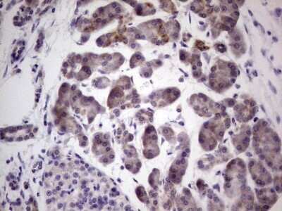 Immunohistochemistry: PRKD3/nPKC nu Antibody (OTI3D8) - Azide and BSA Free [NBP2-73595] - Analysis of Carcinoma of Human pancreas tissue. (Heat-induced epitope retrieval by 1 mM EDTA in 10mM Tris, pH8.5, 120C for 3min)