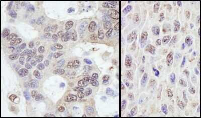 <b>Independent Antibodies Validation and Biological Strategies Validation.</b>Immunohistochemistry: PRKRIR Antibody [NB100-1555] - Sample: FFPE sections of human ovarian carcinoma (left) and mouse squamous cell carcinoma (right). Antibody: Affinity purified rabbit anti- PRKRIR used at a dilution of 1:1,000 (0.2ug/ml) and 1:200 (1ug/ml). Detection: DAB