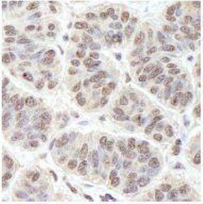 Immunohistochemistry-Paraffin: PRKRIR Antibody [NB100-1555] - FFPE section of human skin basal cell carcinoma.  Affinity purified rabbit anti-PRKRIR used at a dilution of 1:250.