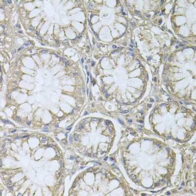 Immunohistochemistry-Paraffin: PRL-3/PTP4A3 Antibody [NBP2-93734] - Paraffin-embedded human gastric cancer using PRL-3/PTP4A3 .