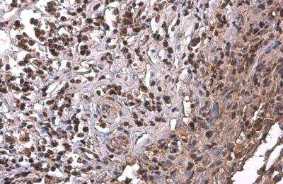 Immunohistochemistry-Paraffin: PRMT1 Antibody (10111) [NBP2-43818] - PRMT1 Antibody (10111) detects PRMT1 protein at cytoplasm and nucleus by immunohistochemical analysis. Sample: Paraffin-embedded human cervical carcinoma. PRMT1 stained by PRMT1 Antibody (10111) diluted at 1:200.