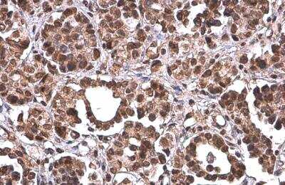 Immunohistochemistry-Paraffin: PRMT1 Antibody (10111) [NBP2-43818] - PRMT1 Antibody (10111) detects PRMT1 protein at cytoplasm and nucleus by immunohistochemical analysis. Sample: Paraffin-embedded human ovarian cancer. PRMT1 stained by PRMT1 Antibody (10111) diluted at 1:200.