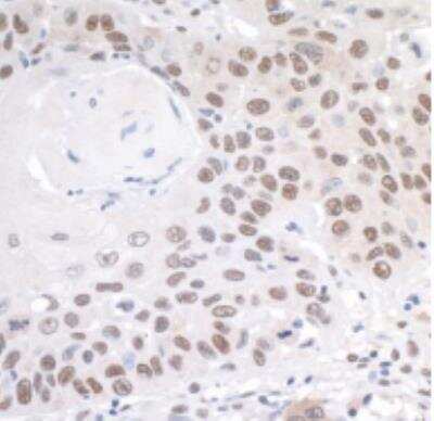 Immunohistochemistry-Paraffin: PRMT1 Antibody [NB100-2251] - Section of human head and neck squamous cell carcinoma. Antibody: Affinity purified rabbit antiPRMT1  used at a dilution of 1:1000 (0.2 ug/ml). Detection: DAB