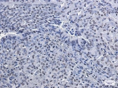 Immunohistochemistry-Paraffin: PRMT1 Antibody (S08-3H8) [NBP3-19745] - Immunohistochemistry of PRMT1 in paraffin-embedded Human breast cancer tissue using NBP3-19745 at dilution 1/20