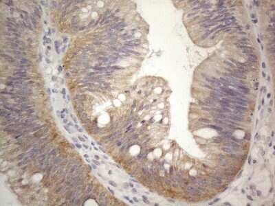 Immunohistochemistry: PRMT5 Antibody (2H3) [NBP2-45394] - Analysis of Carcinoma of Human pancreas tissue. (Heat-induced epitope retrieval by 1mM EDTA in 10mM Tris buffer (pH8.5) at 120C for 3 min)