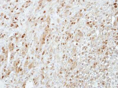 Immunohistochemistry-Paraffin: PRMT5 Antibody [NBP2-19937] - Immunohistochemical analysis of paraffin-embedded Mahlavu xenograft, using antibody at 1:100 dilution.