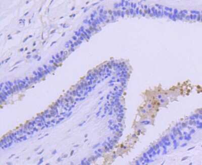 Immunohistochemistry-Paraffin: PRMT5 Antibody (ST51-06) [NBP2-67515] - Analysis of paraffin-embedded human breast carcinoma tissue using anti-PRMT5 antibody. Counter stained with hematoxylin.