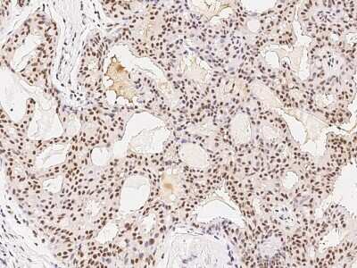 Immunohistochemistry-Paraffin: PRMT7 Antibody [NBP2-98849] - Immunochemical staining of human PRMT7 in human breast carcinoma with rabbit polyclonal antibody (1:2000, formalin-fixed paraffin embedded sections).