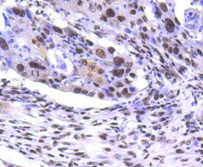 Immunohistochemistry-Paraffin: PRP19 Antibody (SC06-53) [NBP2-67597] - Analysis of paraffin-embedded human lung cancer tissue using anti-PRP19 antibody. Counter stained with hematoxylin.
