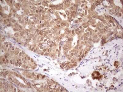 Immunohistochemistry: PRPK Antibody (5B2) [NBP2-46196] - Analysis of Carcinoma of Human liver tissue. (Heat-induced epitope retrieval by 1 mM EDTA in 10mM Tris, pH8.5, 120C for 3min)