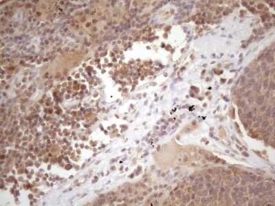 Immunohistochemistry: PRPK Antibody (5B2) [NBP2-46196] - Analysis of Carcinoma of Human lung tissue. (Heat-induced epitope retrieval by 1 mM EDTA in 10mM Tris, pH8.5, 120C for 3min)