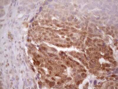 Immunohistochemistry: PRPK Antibody (5B2) [NBP2-46196] - Analysis of Adenocarcinoma of Human ovary tissue. (Heat-induced epitope retrieval by 1 mM EDTA in 10mM Tris, pH8.5, 120C for 3min)