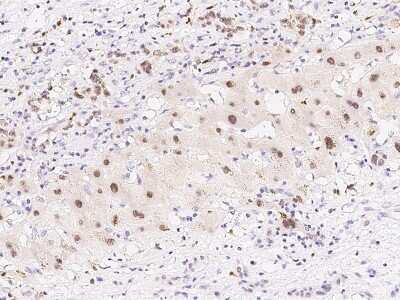 Immunohistochemistry-Paraffin: PRPK Antibody [NBP2-99394] - Immunochemical staining of human PRPK in human hepatoma with rabbit polyclonal antibody at 1:500 dilution, formalin-fixed paraffin embedded sections.