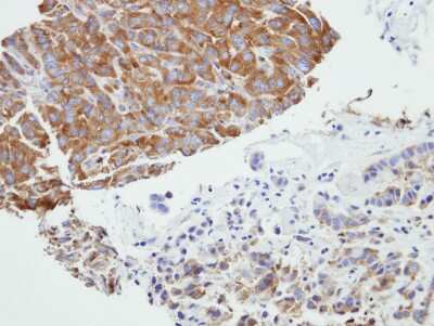 Immunohistochemistry-Paraffin: PRPSAP2 Antibody [NBP1-32630] - A549 xenograft, using PRPSAP2  antibody at 1:500 dilution. Antigen Retrieval: Citrate buffer, pH 6.0, 15 min.