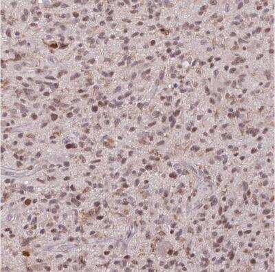 Immunohistochemistry-Paraffin: PRRX1 Antibody [NBP2-13816] - Staining of human malignant glioma shows moderate to strong nuclear positivity in tumor cells.